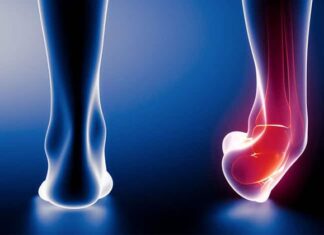 cara mengobati cedera ankle